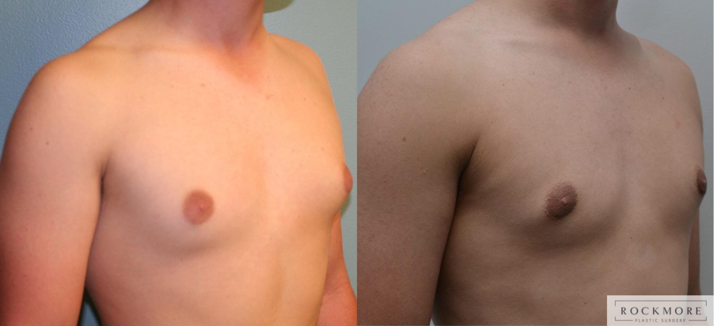 Before & After Male Breast Reduction (Gynecomastia) Case 187 View #2 View in Albany & Latham, New York