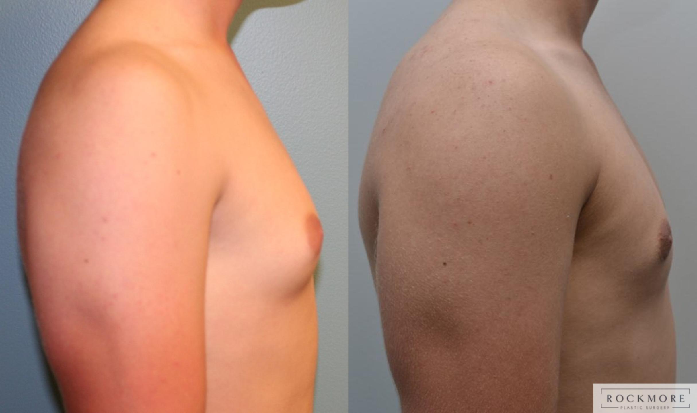 Before & After Male Breast Reduction (Gynecomastia) Case 187 View #3 View in Albany & Latham, New York