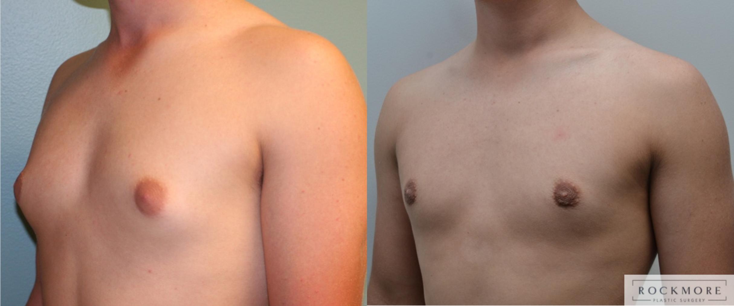 Before & After Male Breast Reduction (Gynecomastia) Case 187 View #4 View in Albany & Latham, New York