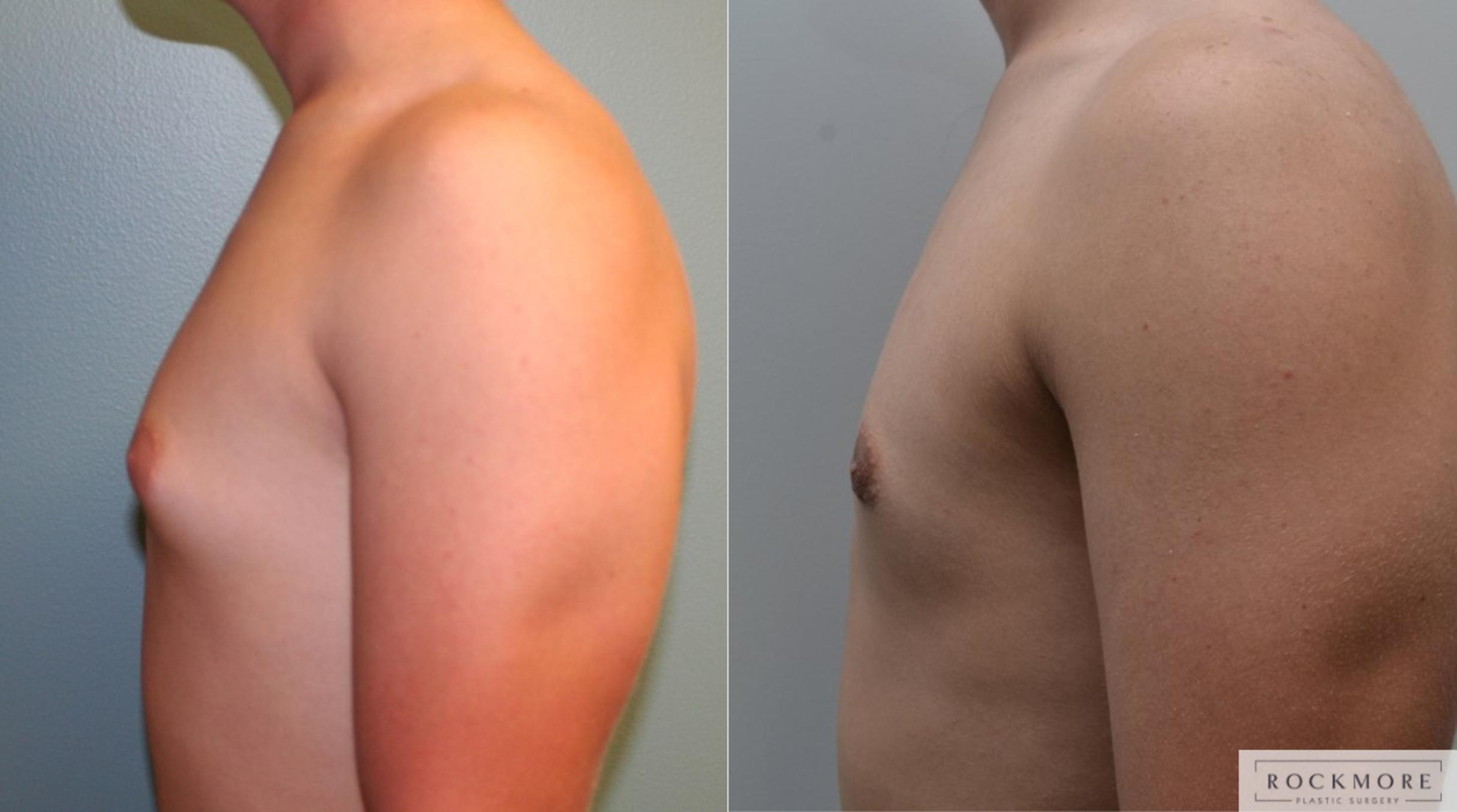 Before & After Male Breast Reduction (Gynecomastia) Case 187 View #5 View in Albany & Latham, New York