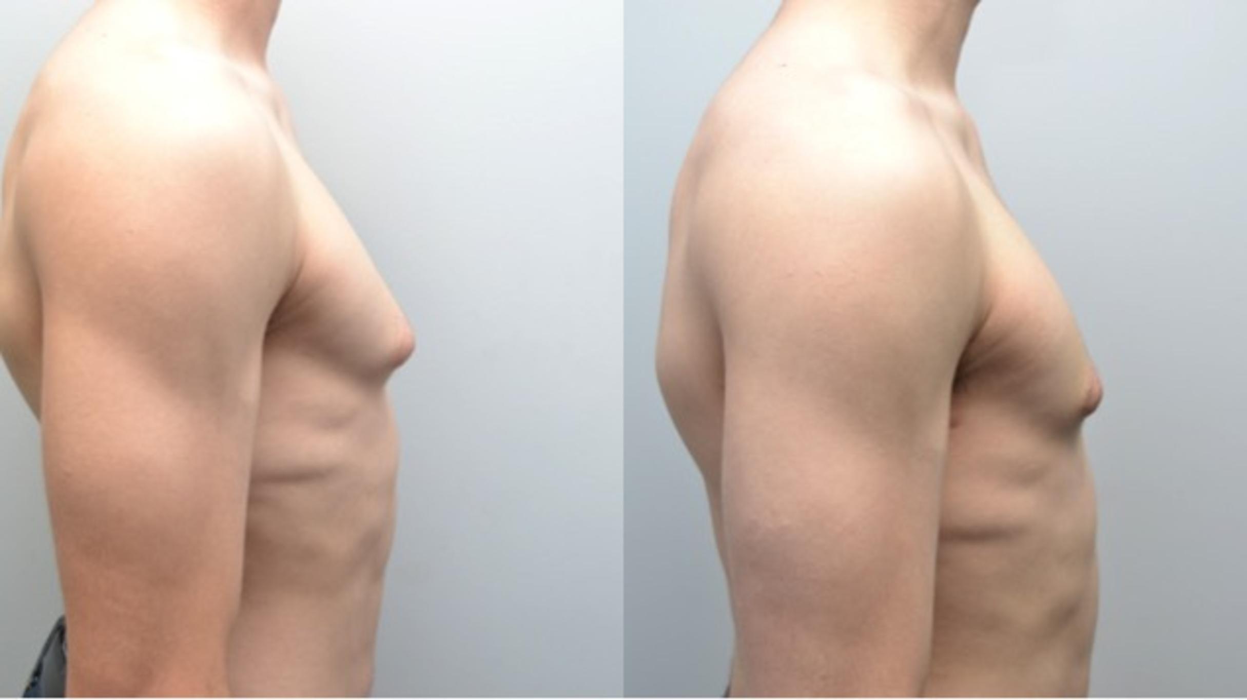 Gynecomastia Surgery Before and After