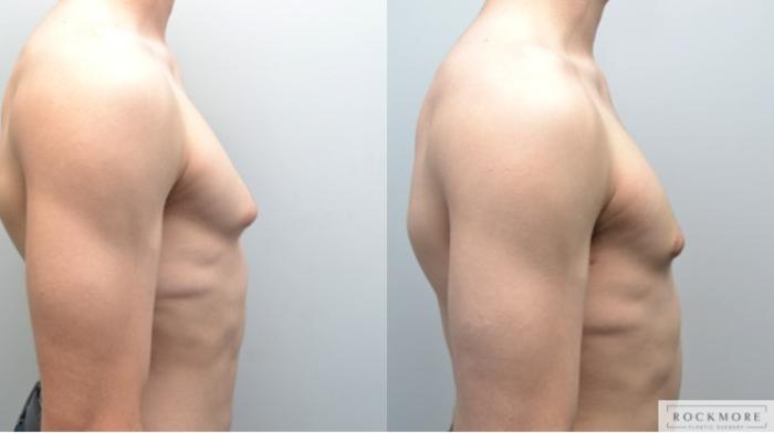Before & After Male Breast Reduction (Gynecomastia) Case 247 View #1 View in Albany & Latham, New York