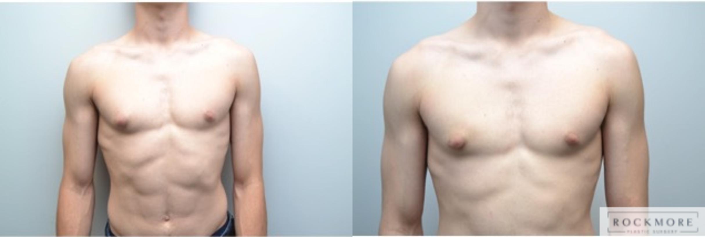 Before & After Male Breast Reduction (Gynecomastia) Case 247 View #2 View in Albany & Latham, New York