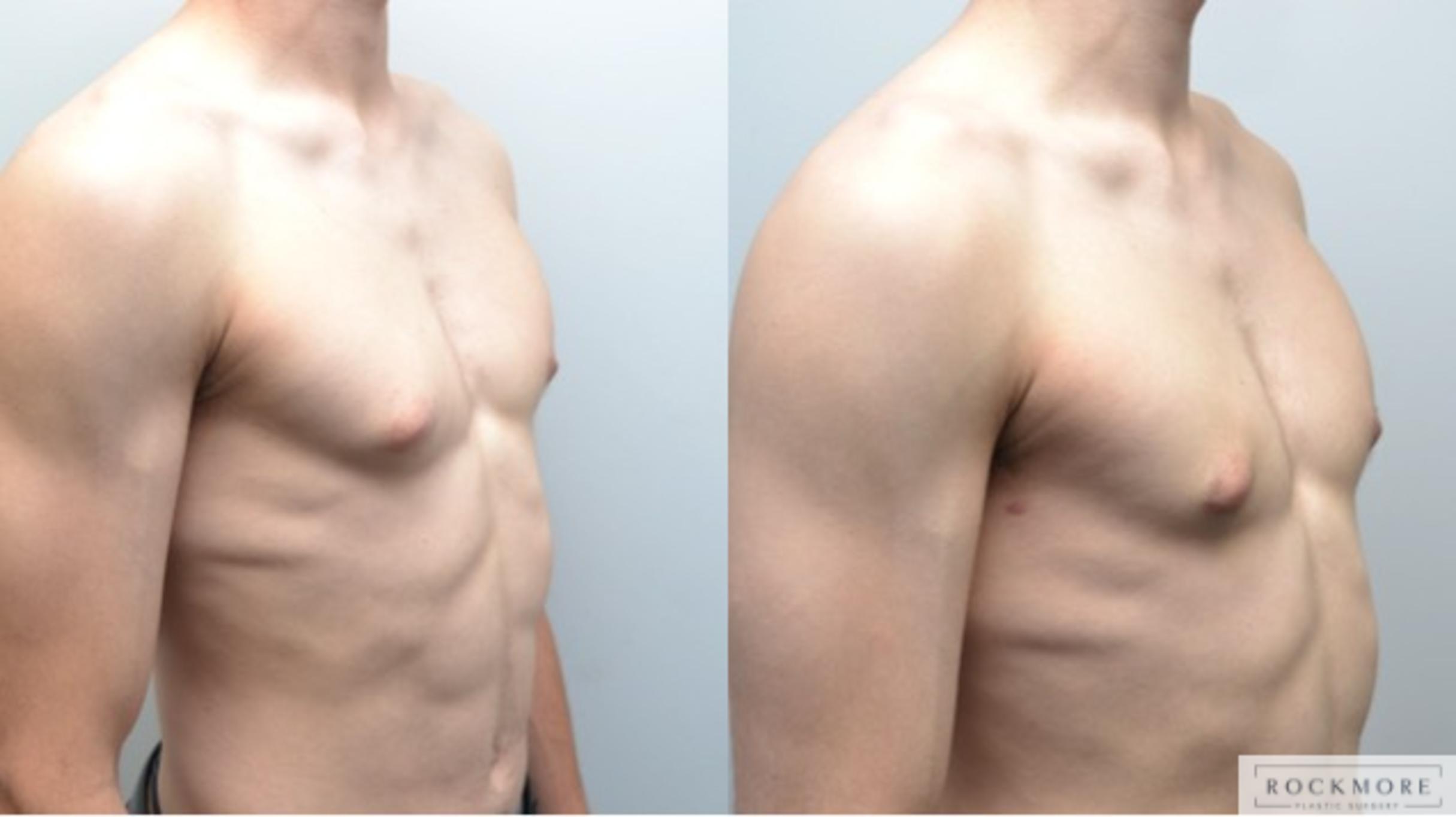 Before & After Male Breast Reduction (Gynecomastia) Case 247 View #3 View in Albany & Latham, New York