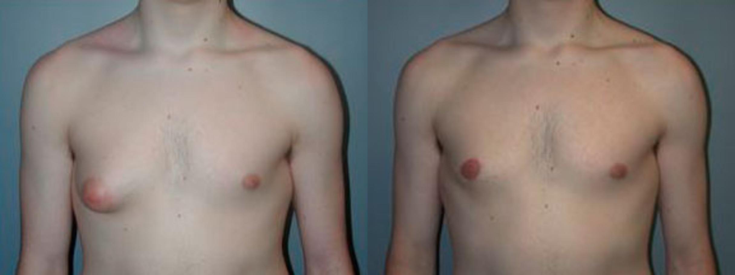 Before & After Male Breast Reduction (Gynecomastia) Case 83 View #1 View in Albany & Latham, New York