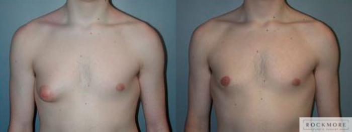 Before & After Male Breast Reduction (Gynecomastia) Case 83 View #1 View in Albany & Latham, New York