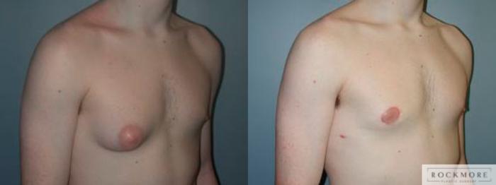 Before & After Male Breast Reduction (Gynecomastia) Case 83 View #2 View in Albany & Latham, New York