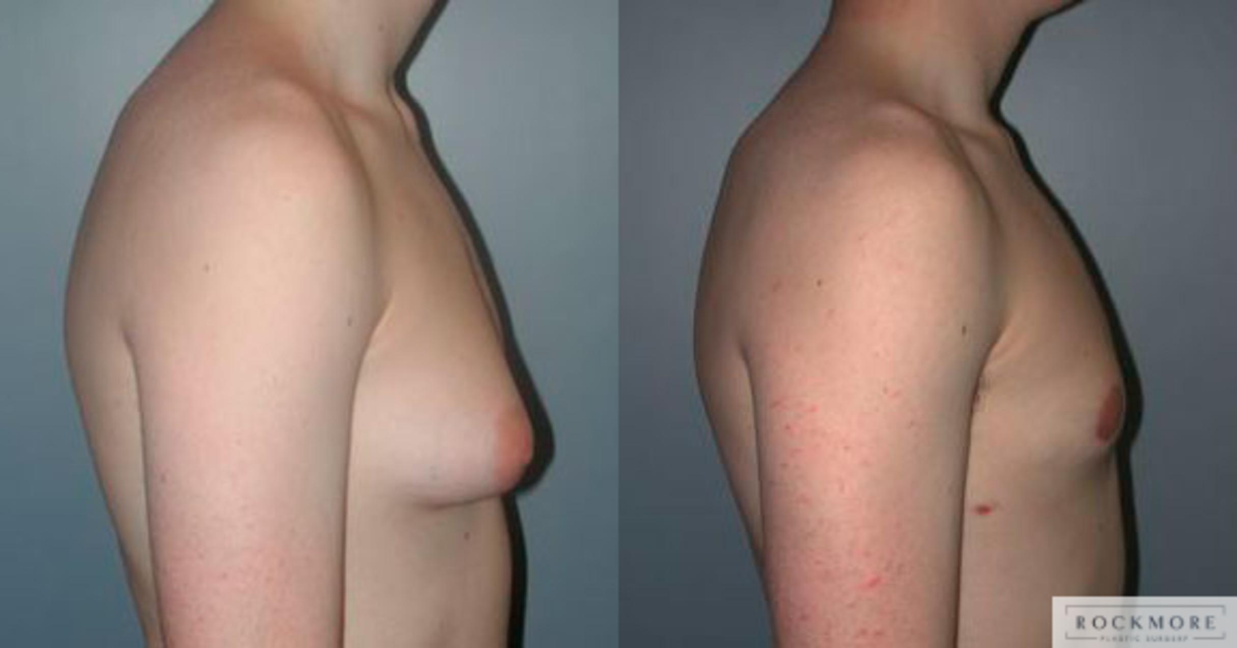 Before & After Male Breast Reduction (Gynecomastia) Case 83 View #3 View in Albany & Latham, New York