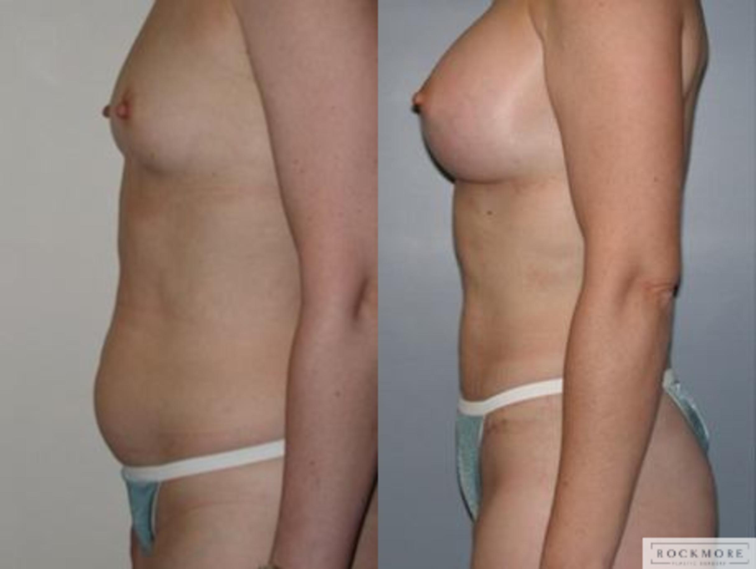 Before & After Tummy Tuck Case 140 View #2 View in Albany & Latham, New York