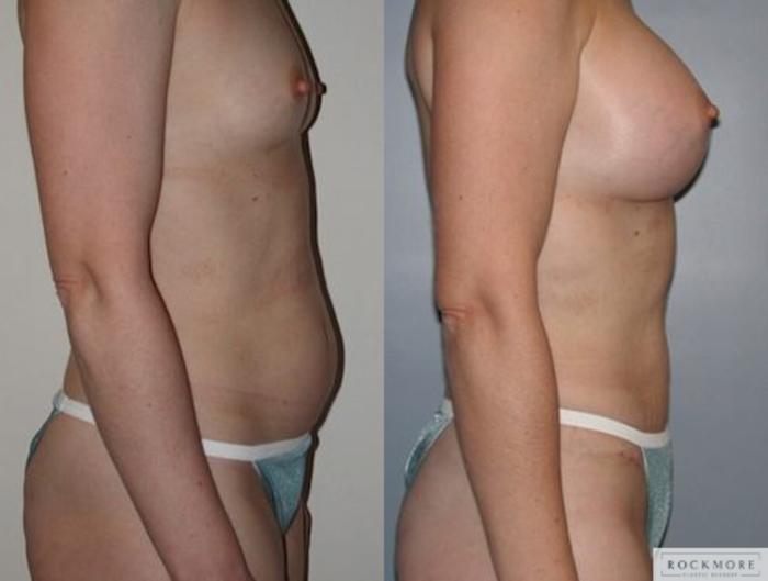 Before & After Tummy Tuck Case 140 View #3 View in Albany & Latham, New York