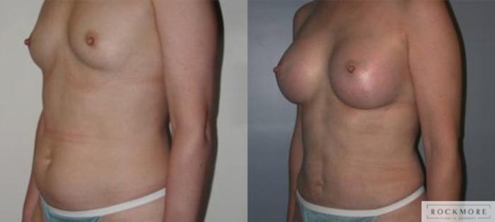 Before & After Tummy Tuck Case 140 View #4 View in Albany & Latham, New York