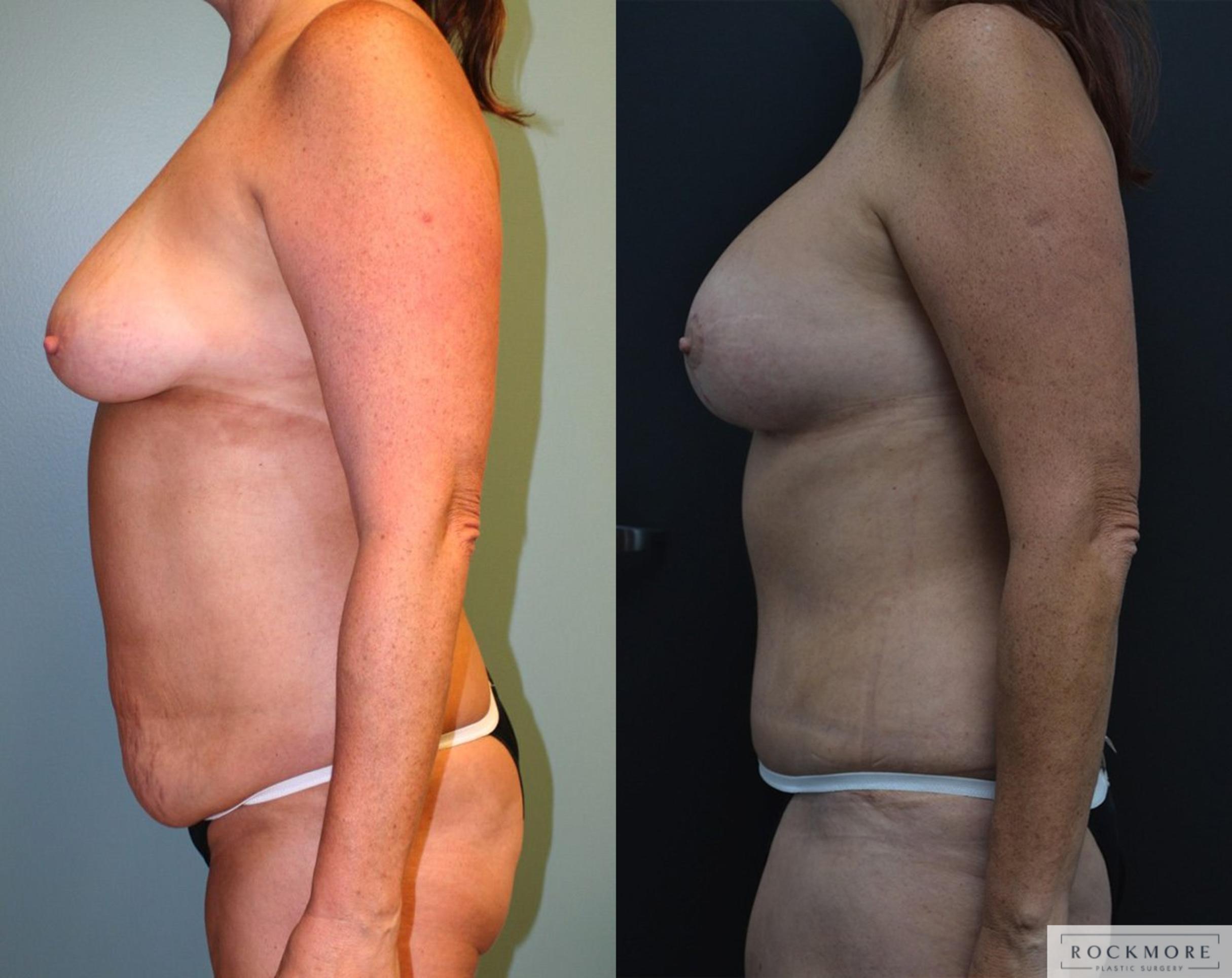 Before & After Mommy Makeover Case 163 View #2 View in Albany & Latham, New York