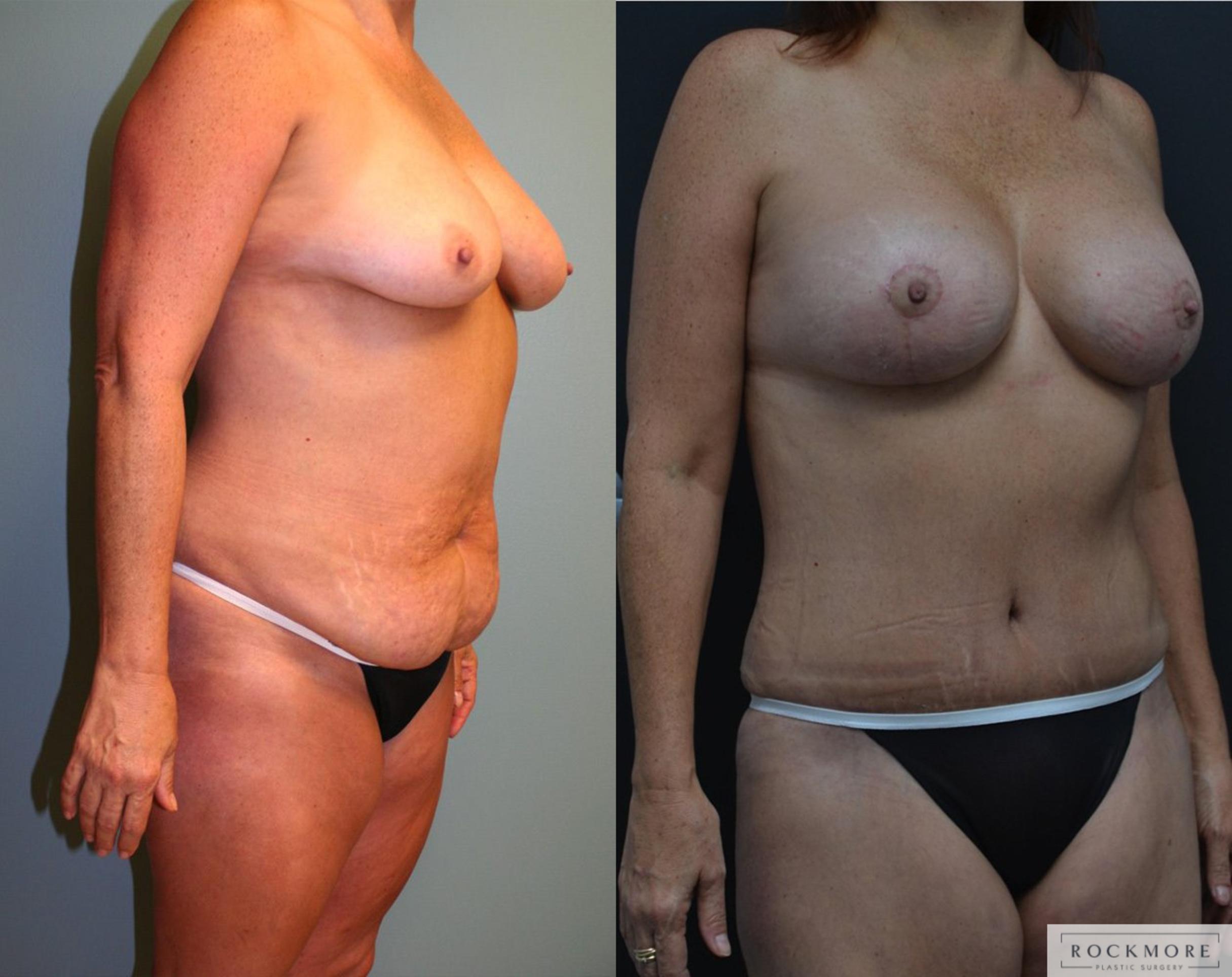Before & After Mommy Makeover Case 163 View #4 View in Albany & Latham, New York