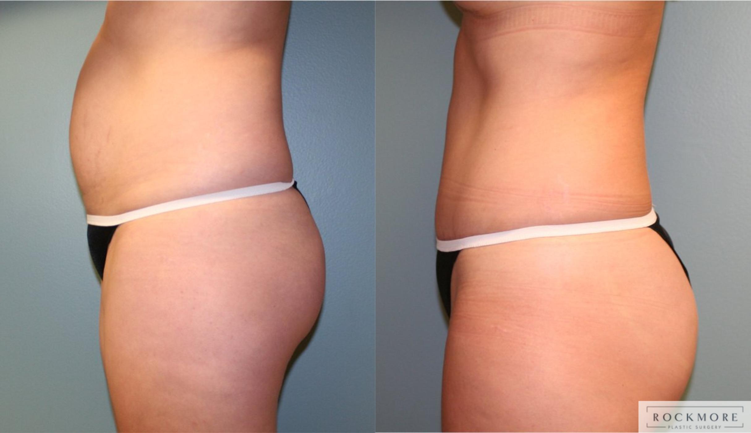 Before & After Featured Cases Case 172 View #4 View in Albany & Latham, New York