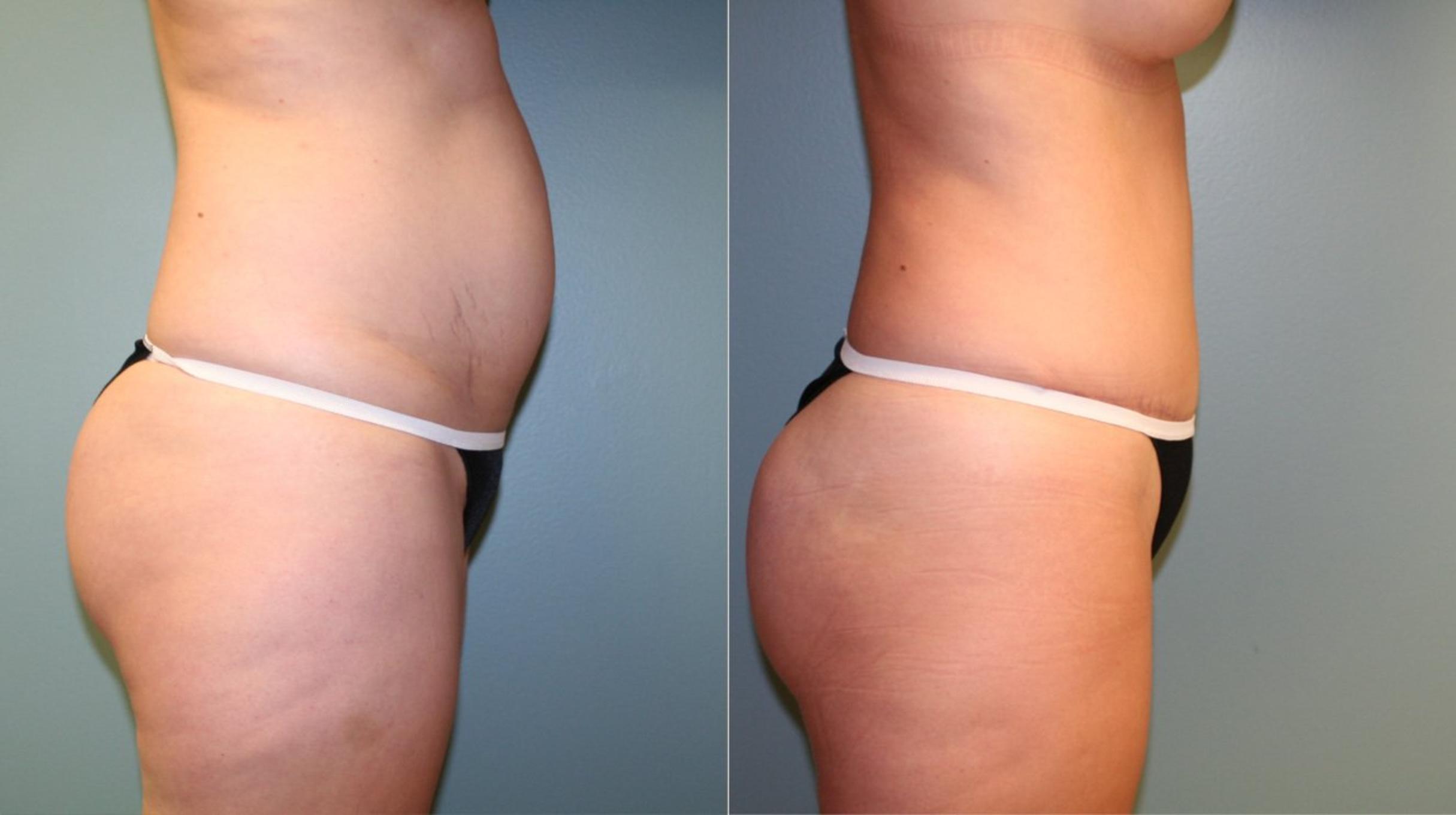 Before & After Featured Cases Case 172 View #6 View in Albany & Latham, New York