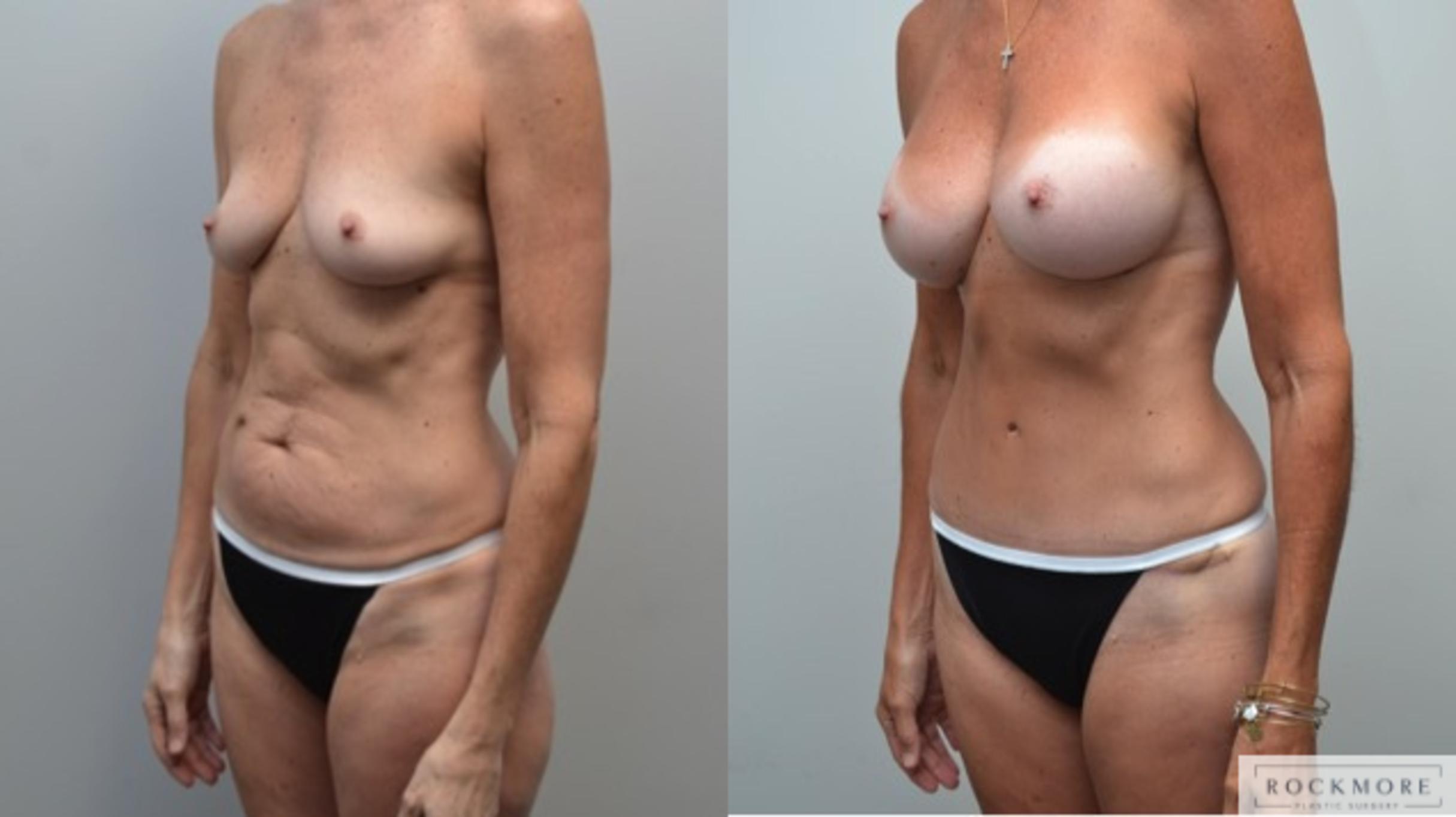 Before & After Mommy Makeover Case 235 View #6 View in Albany & Latham, New York