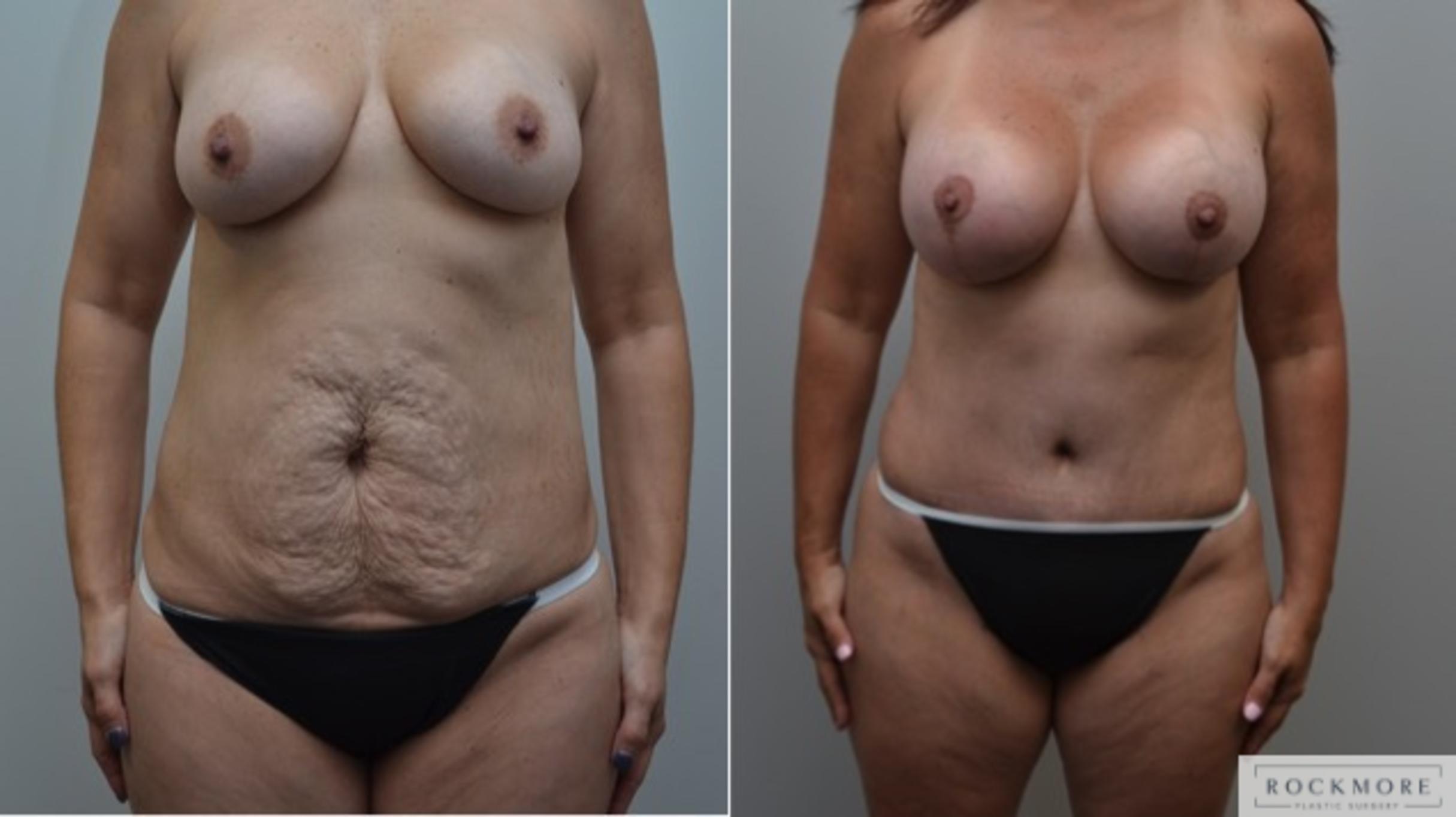 Before & After Breast Augmentation Case 253 View #1 View in Albany & Latham, New York