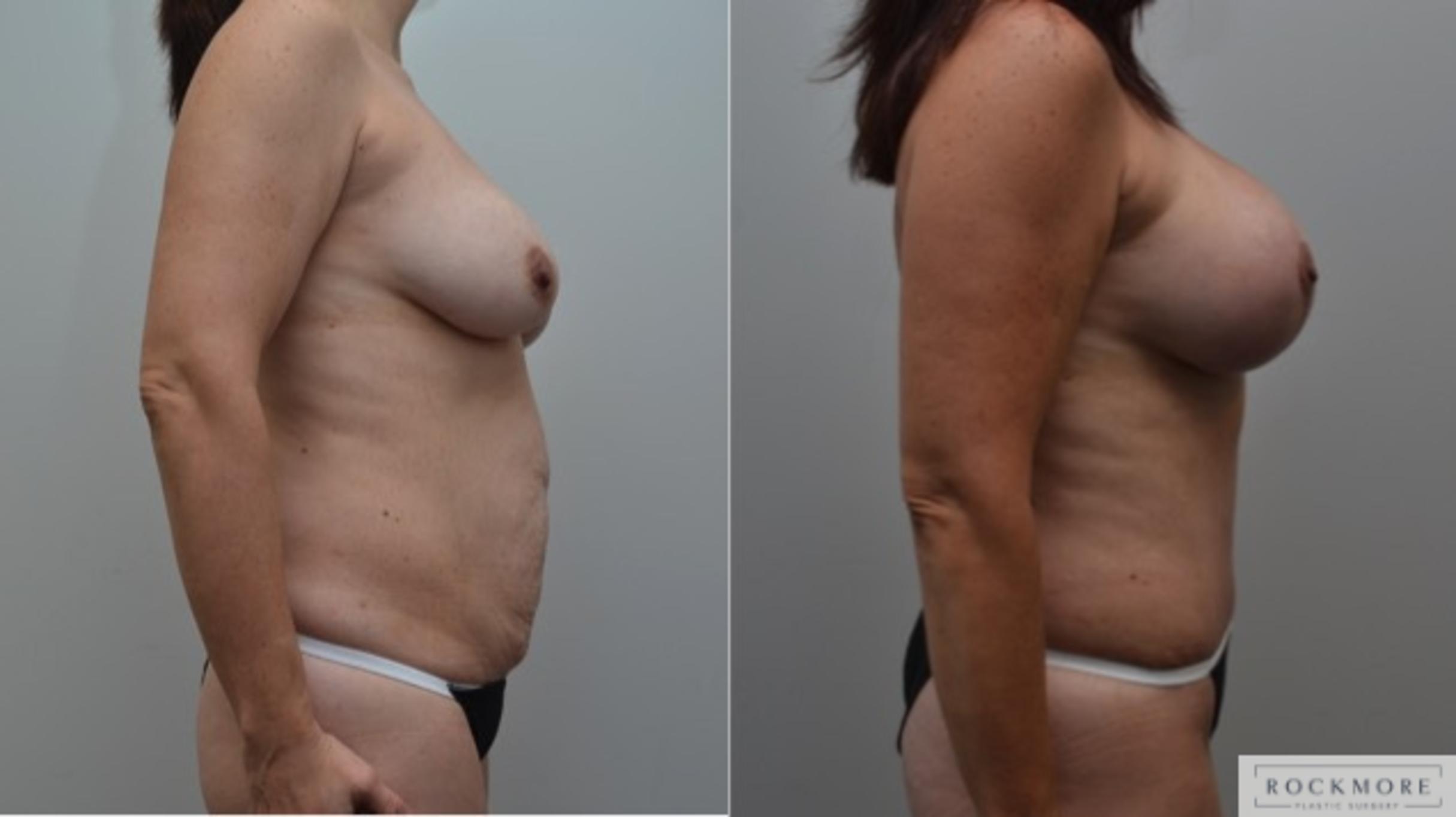 Before & After Mommy Makeover Case 253 View #3 View in Albany & Latham, New York