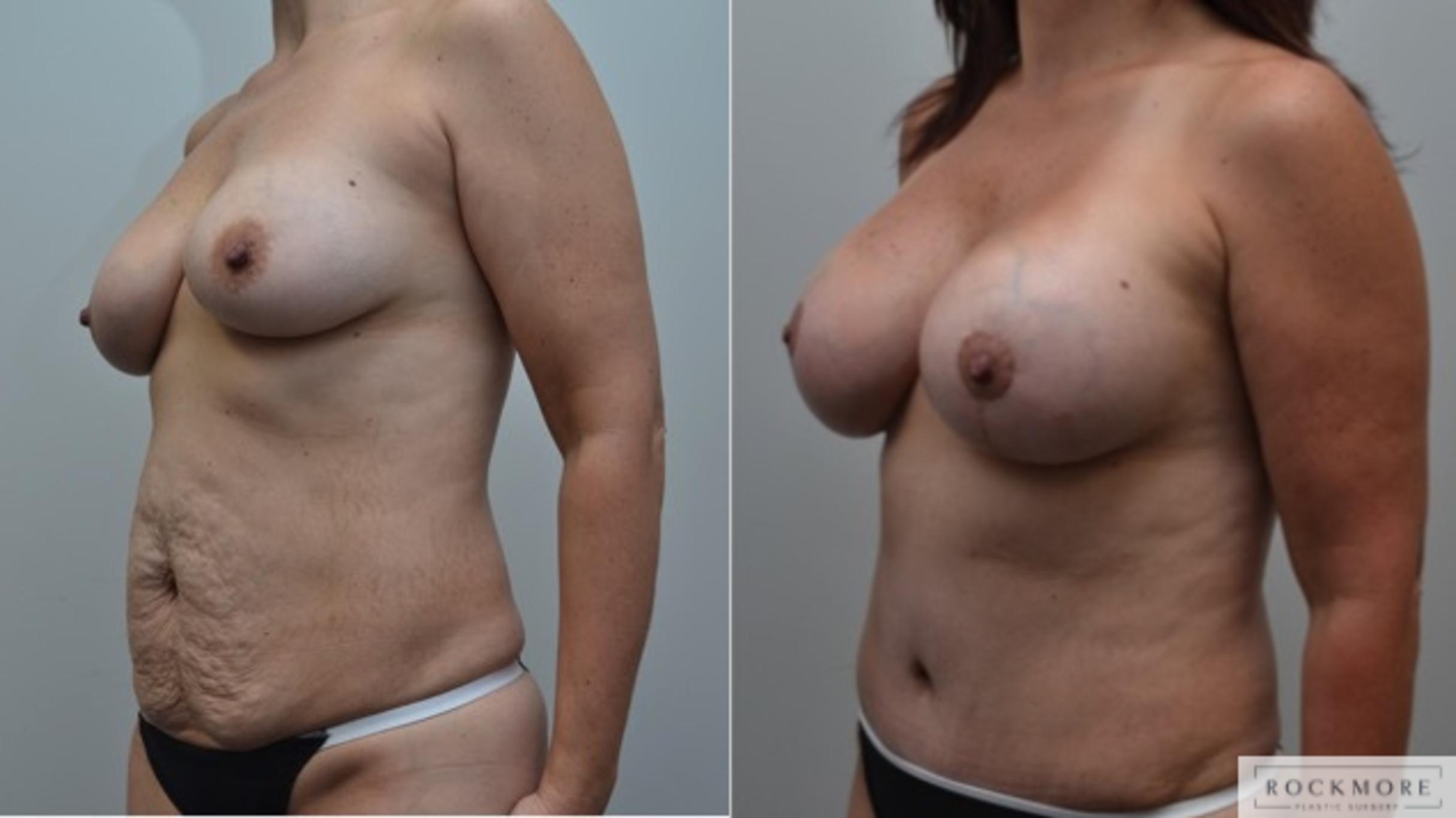 Before & After Breast Augmentation Case 253 View #5 View in Albany & Latham, New York