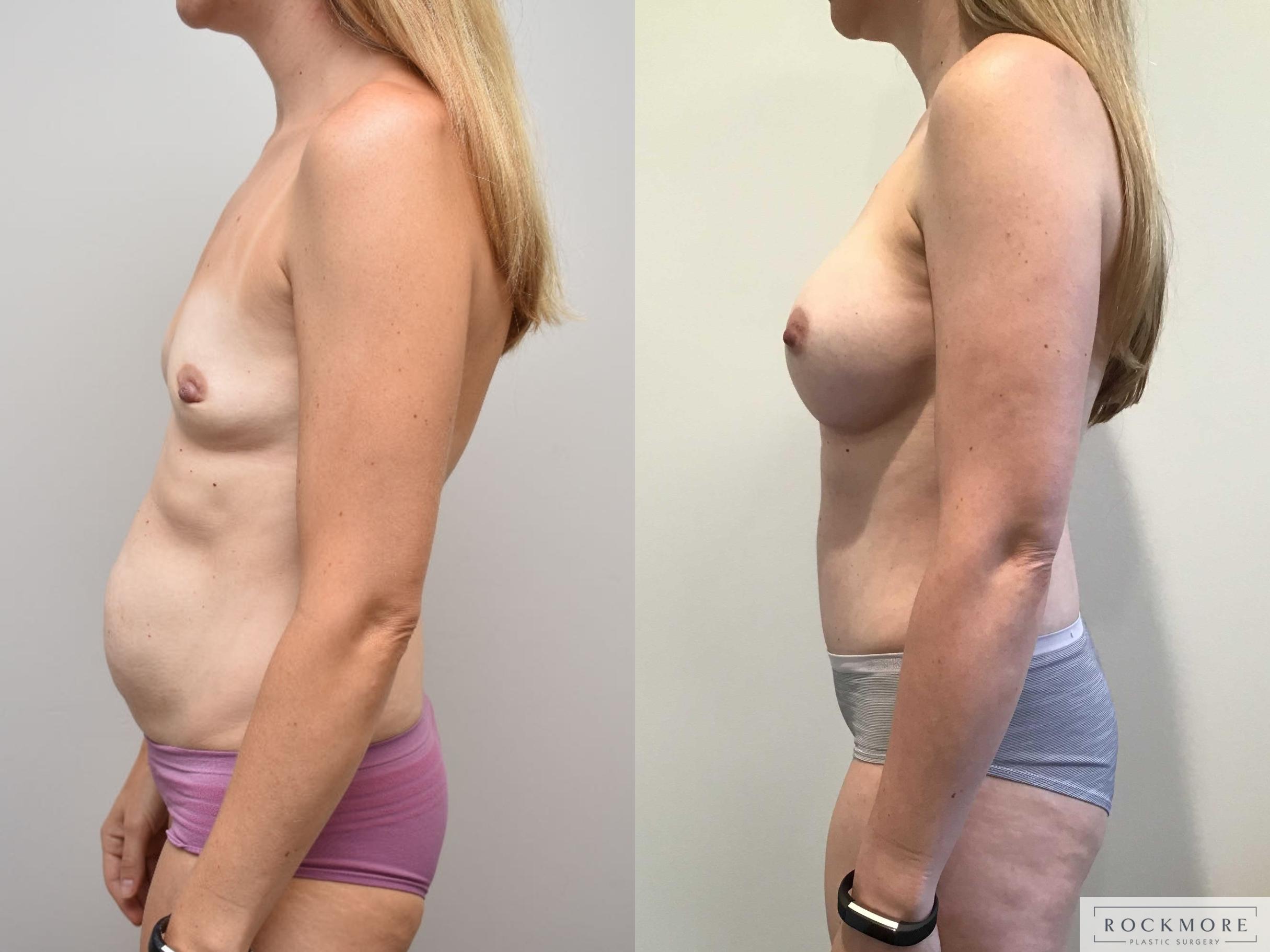 Before & After Mommy Makeover Case 325 Left Side View in Albany & Latham, New York