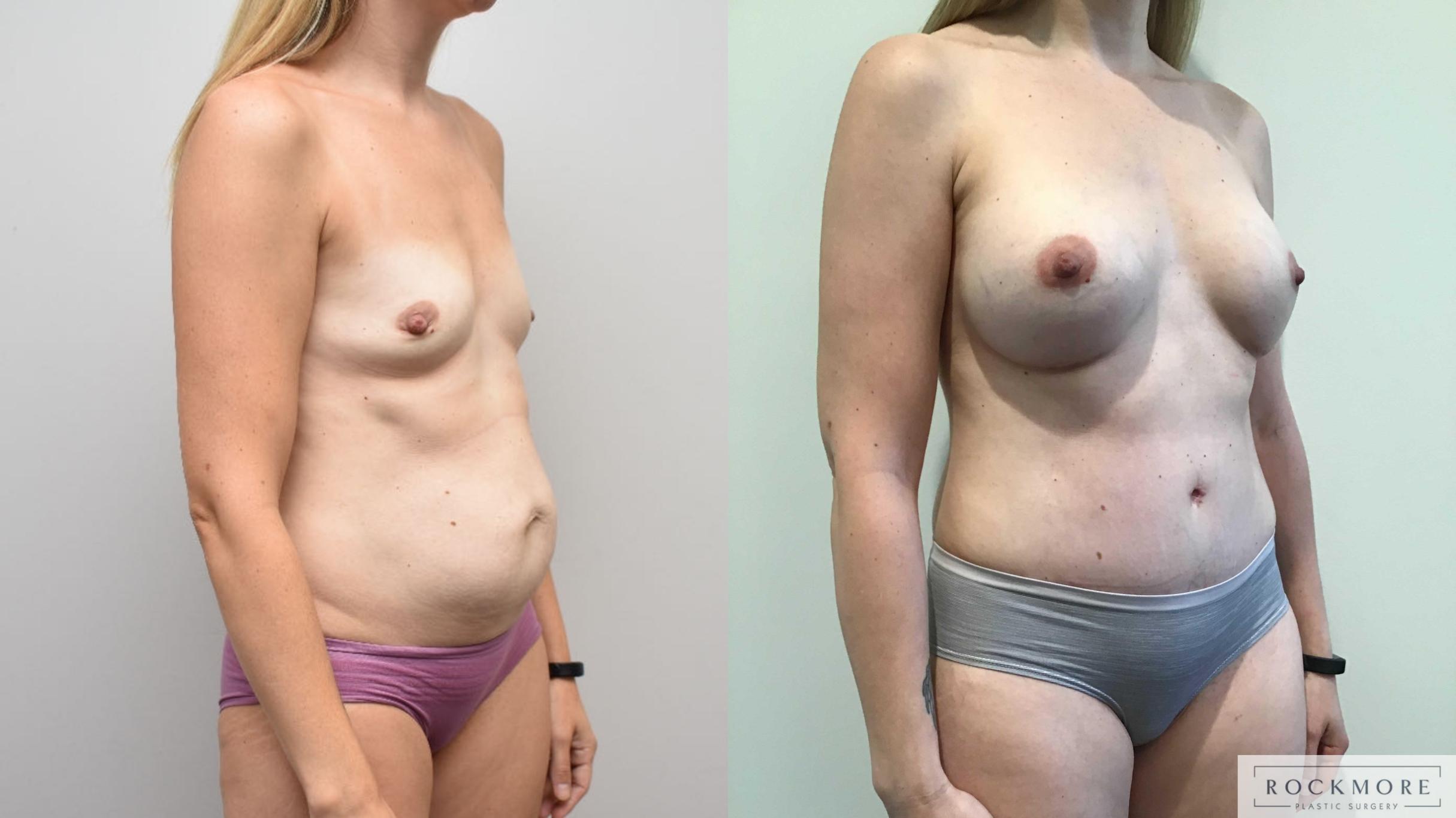 Before & After Mommy Makeover Case 325 Right Oblique View in Albany & Latham, New York