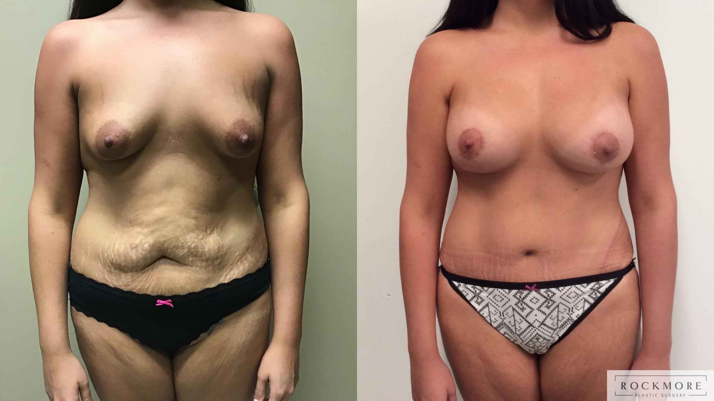 Before & After Tummy Tuck Case 326 Front View in Albany & Latham, New York