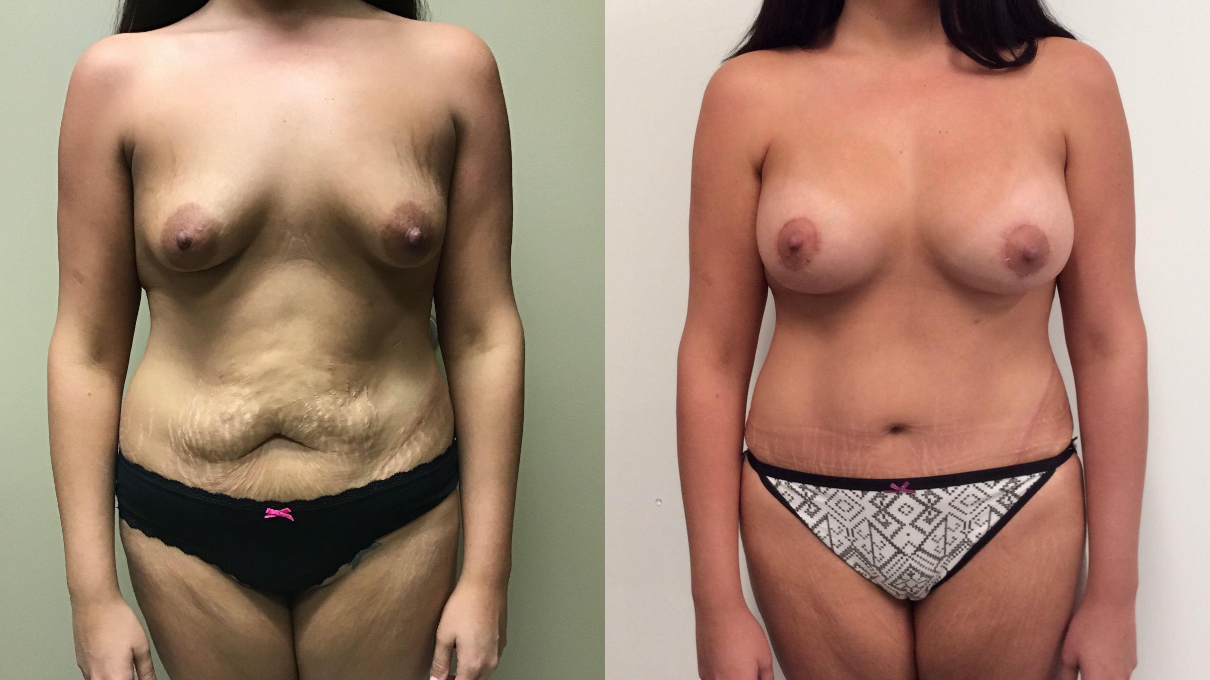 Before & After Tummy Tuck Case 326 Front View in Albany & Latham, New York