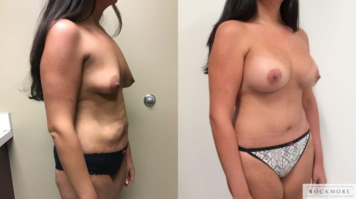 Before & After Mommy Makeover Case 326 Right Oblique View in Albany & Latham, New York