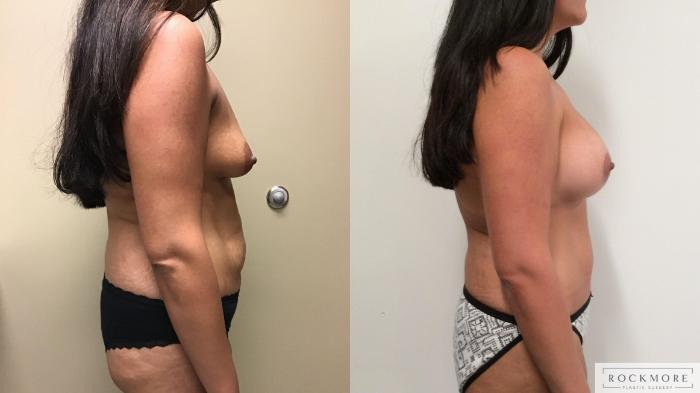 Before & After Mommy Makeover Case 326 Right Side View in Albany & Latham, New York