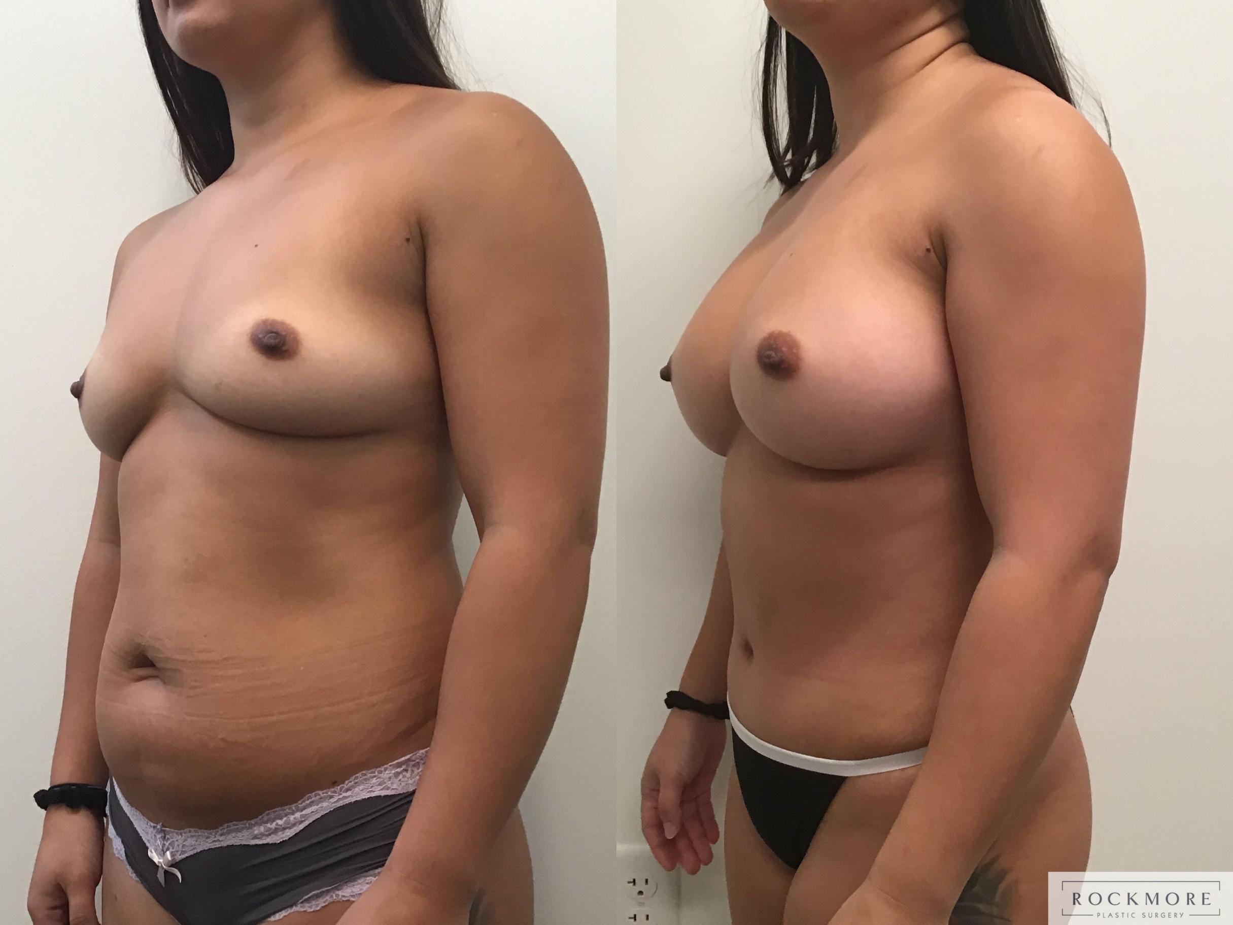 Before & After Mommy Makeover Case 327 Left Oblique View in Albany & Latham, New York