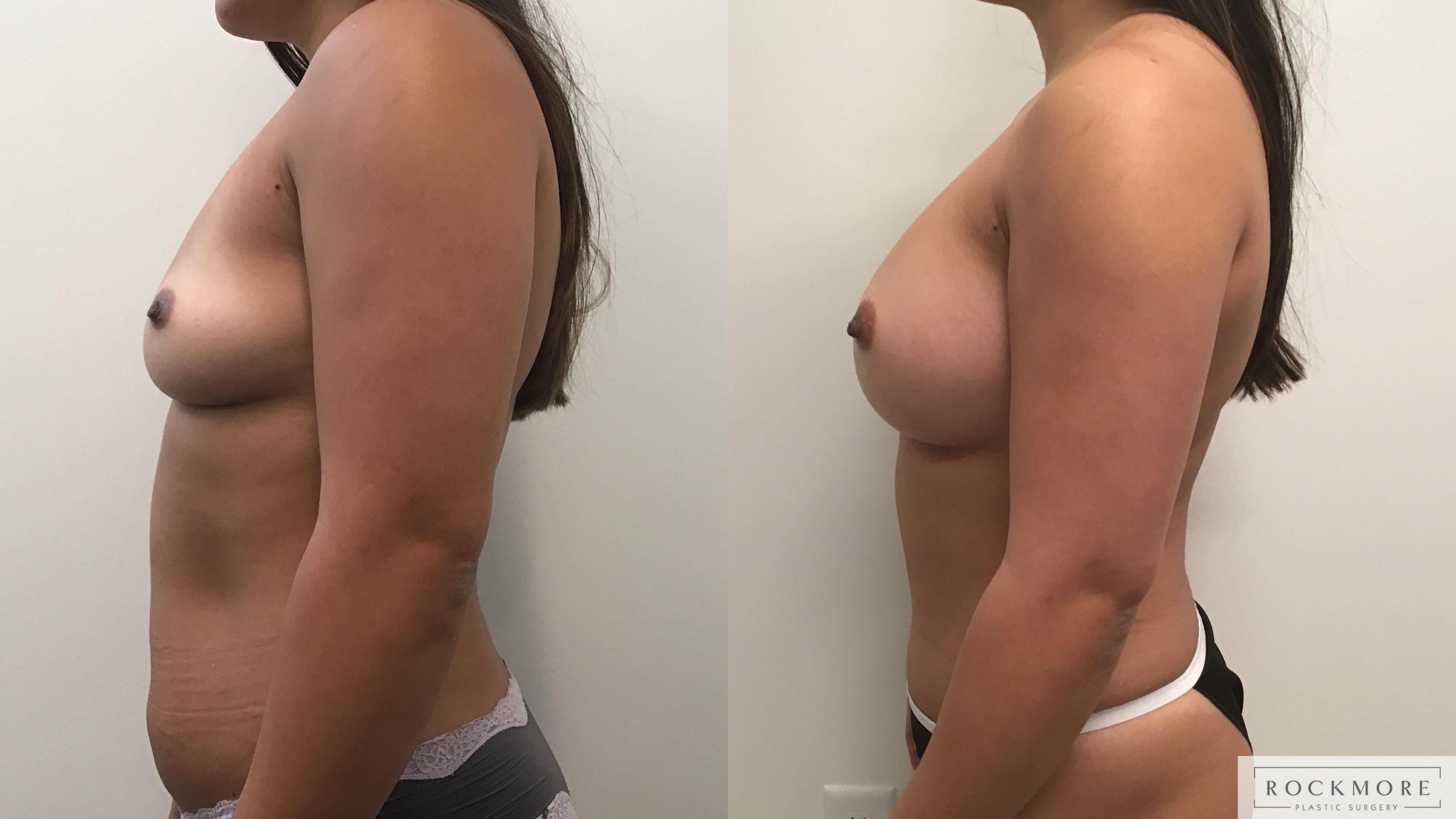 Before & After Mommy Makeover Case 327 Left Side View in Albany & Latham, New York