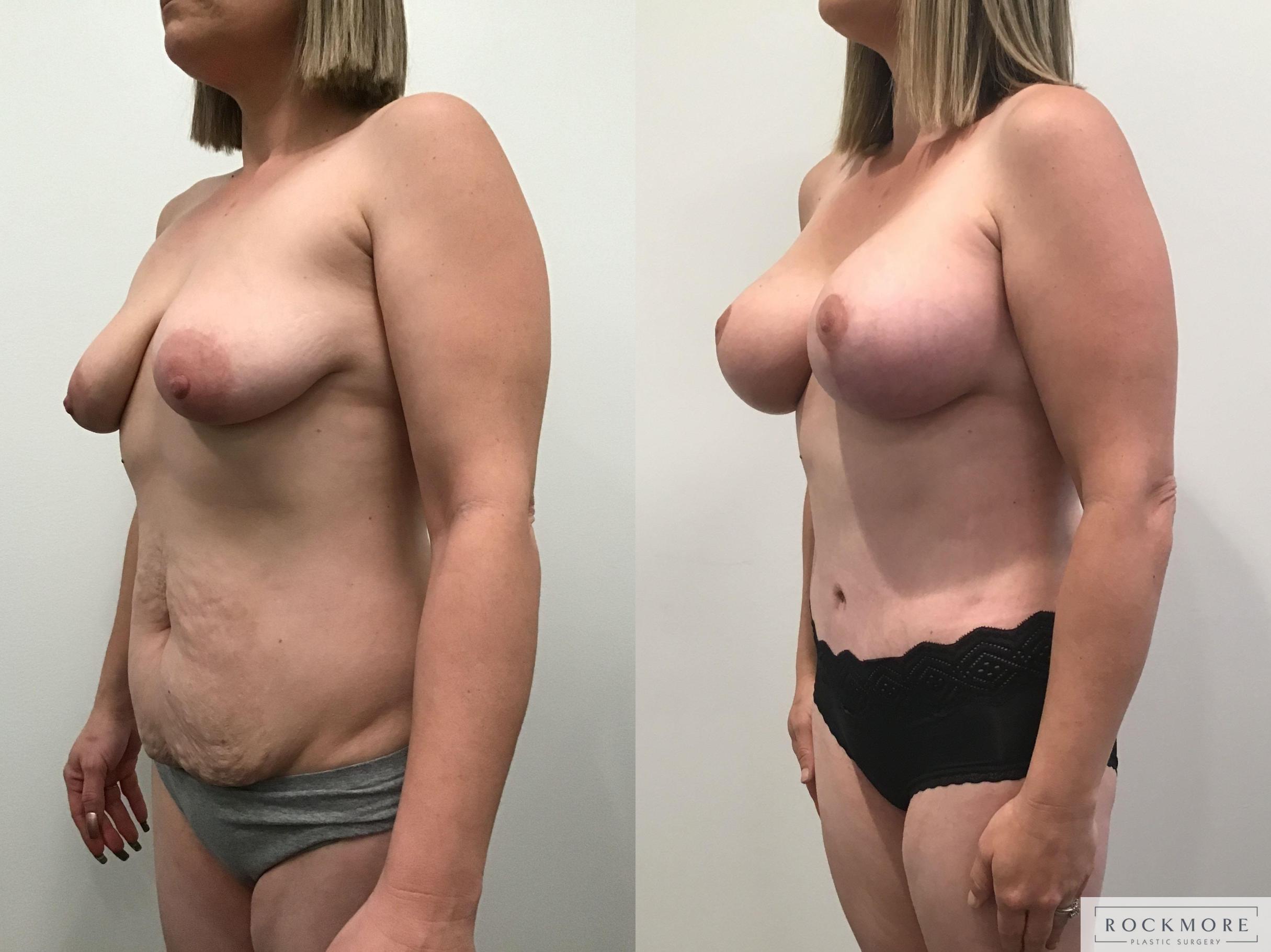 Before & After Mommy Makeover Case 340 Left Oblique View in Albany & Latham, New York