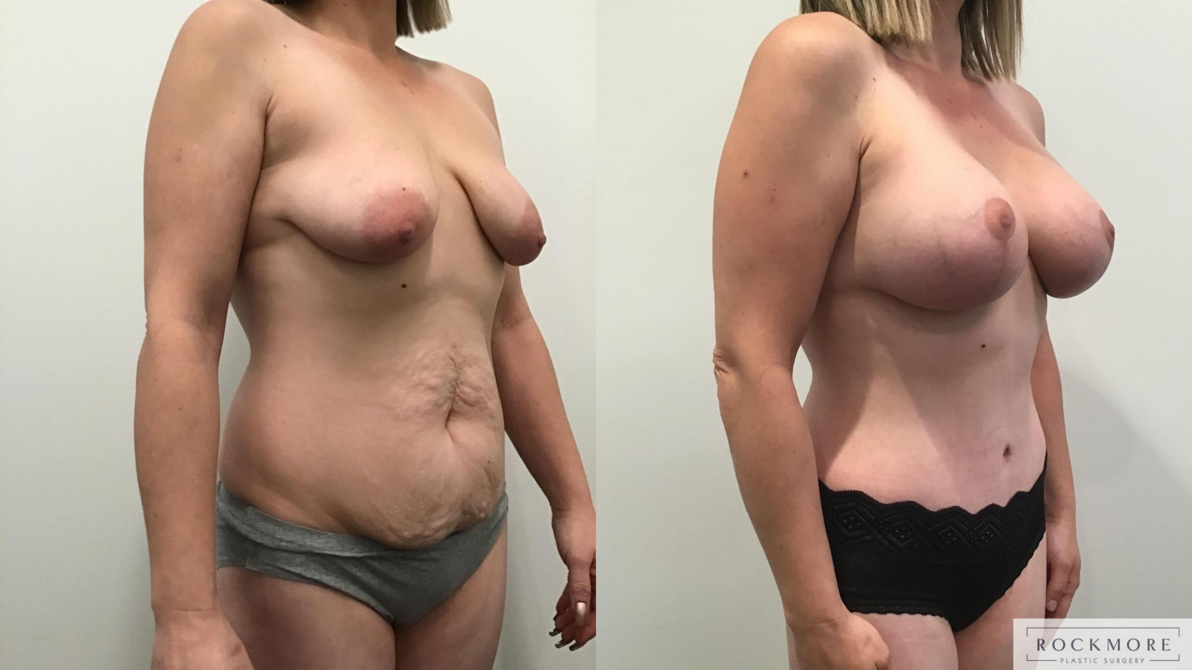 Before & After Mommy Makeover Case 340 Right Oblique View in Albany & Latham, New York