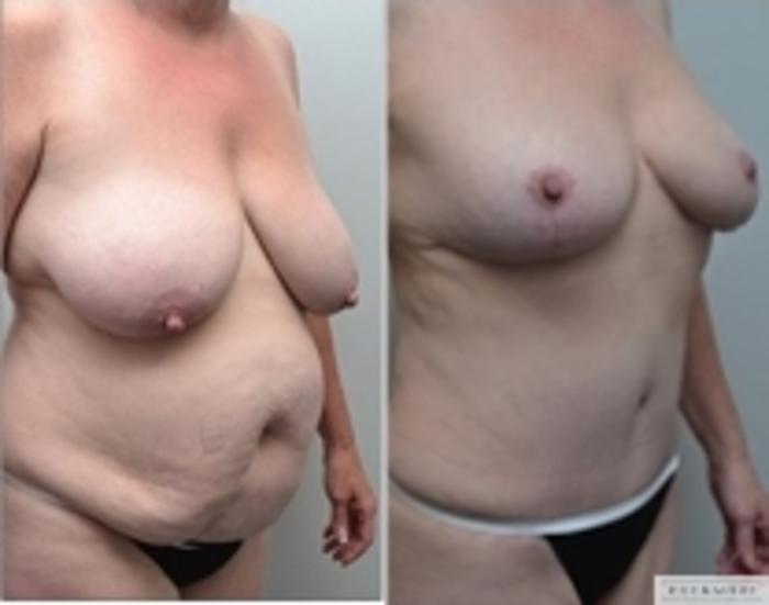 Before & After Mommy Makeover Case 364 Right Oblique View in Albany & Latham, New York