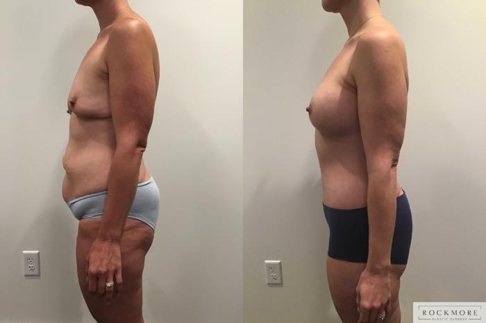 Before & After Mommy Makeover Case 376 Left Side View in Albany & Latham, New York