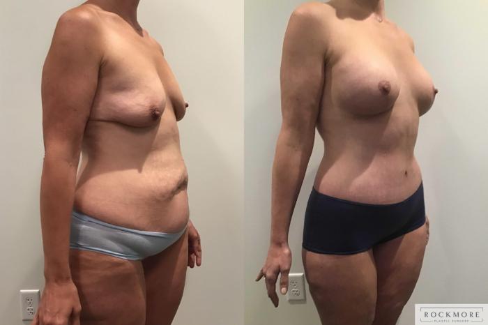 Before & After Mommy Makeover Case 376 Right Oblique View in Albany & Latham, New York