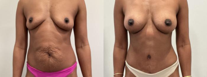 Before & After Mommy Makeover Case 480 Front View in Albany, Latham & Saratoga, New York