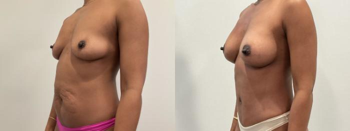 Before & After Mommy Makeover Case 480 Left Oblique View in Albany, Latham & Saratoga, New York