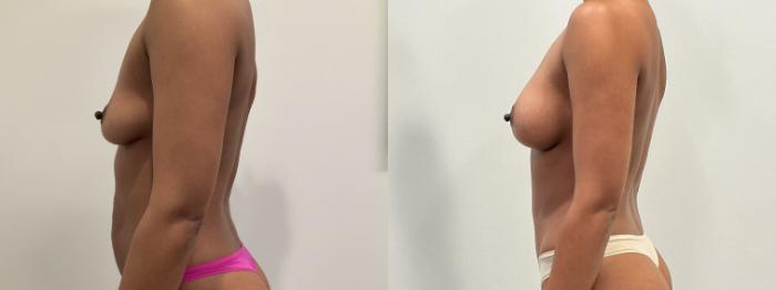 Before & After Mommy Makeover Case 480 Left Side View in Albany, Latham & Saratoga, New York