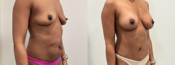 Before & After Mommy Makeover Case 480 Right Oblique View in Albany, Latham & Saratoga, New York