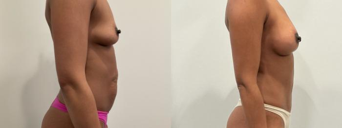 Before & After Mommy Makeover Case 480 Right Side View in Albany, Latham & Saratoga, New York