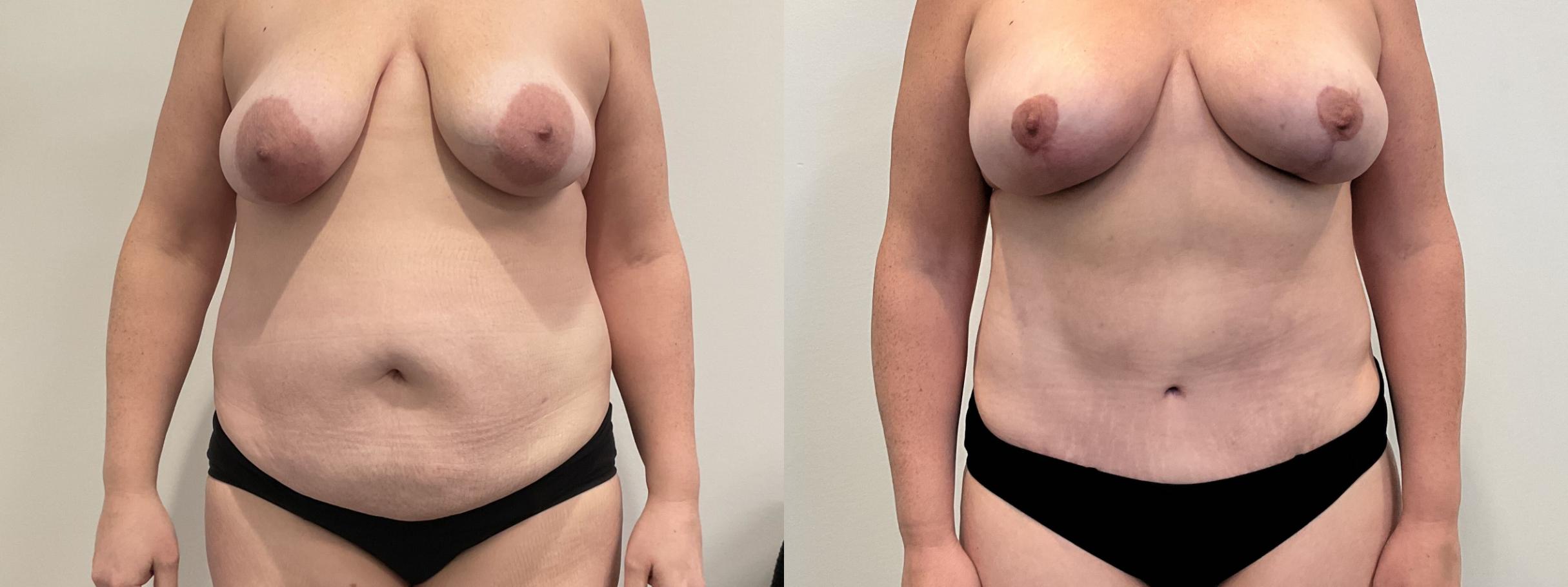 Before & After Mommy Makeover Case 507 Front View in Albany, Latham & Saratoga, New York