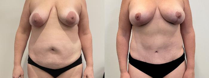 Before & After Mommy Makeover Case 507 Front View in Albany, Latham & Saratoga, New York