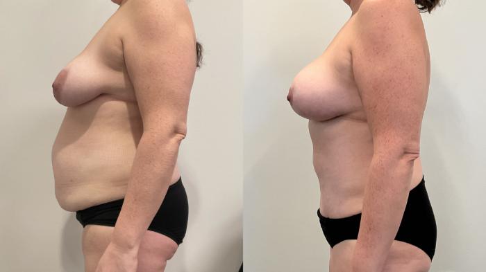 Before & After Mommy Makeover Case 507 Left Side View in Albany, Latham & Saratoga, New York