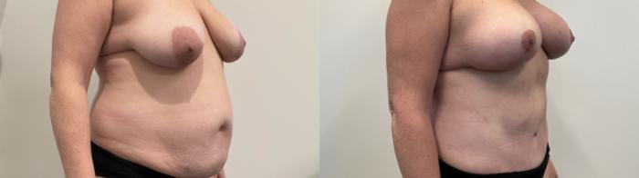 Before & After Mommy Makeover Case 507 Right Oblique View in Albany, Latham & Saratoga, New York