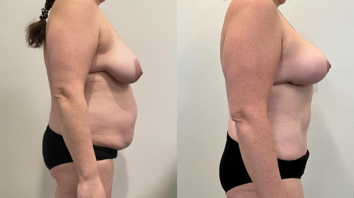 Before & After Mommy Makeover Case 507 Right Side View in Albany, Latham & Saratoga, New York