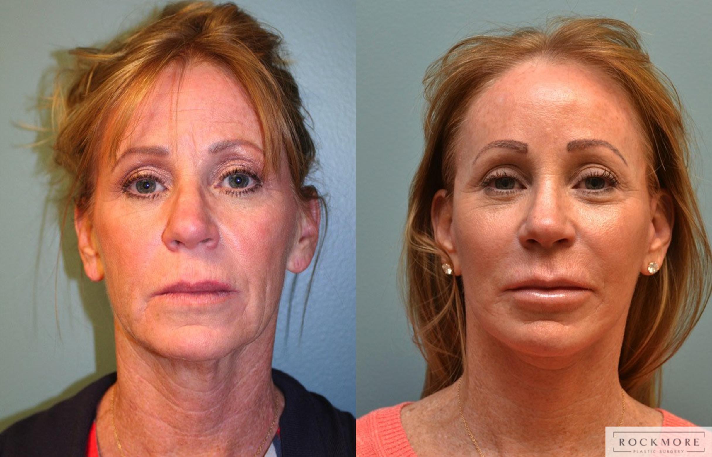 Before & After Facelift Case 158 View #1 View in Albany & Latham, New York