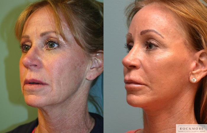 Before & After Facelift Case 158 View #2 View in Albany & Latham, New York