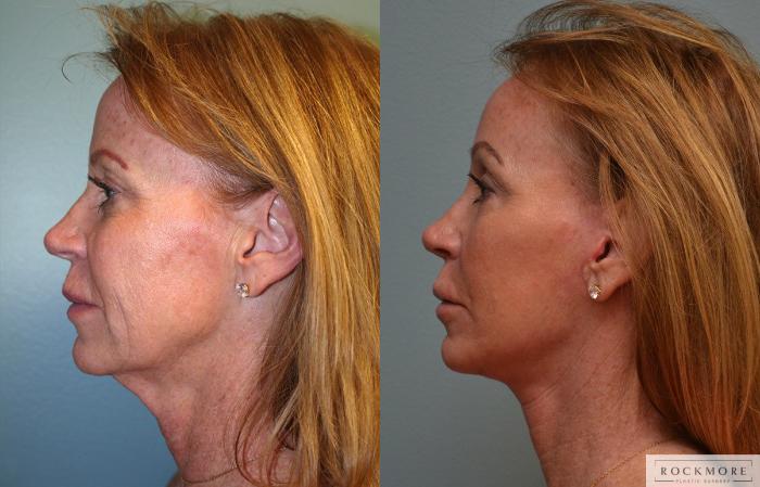 Before & After Neck Lift Case 158 View #3 View in Albany & Latham, New York