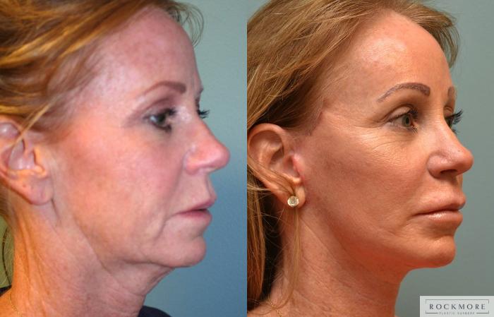 Before & After Neck Lift Case 158 View #4 View in Albany & Latham, New York